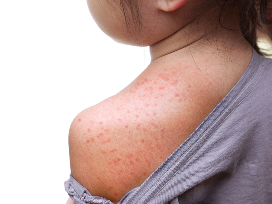 girl with measles rash